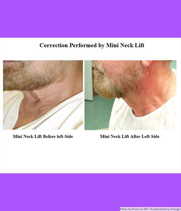 Correction Performed By Mini-Neck Lift, Left Side View Cost is $3200.00