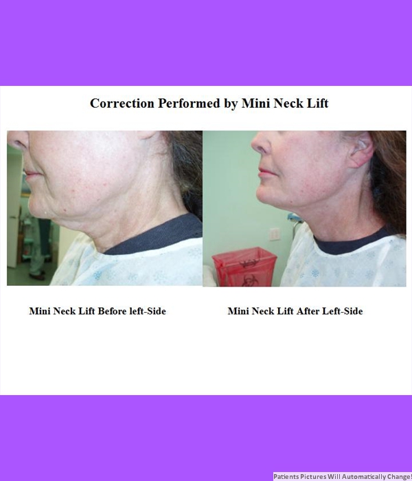 Correction Performed By Mini-Neck Lift, Left Side View Cost is $3200.00